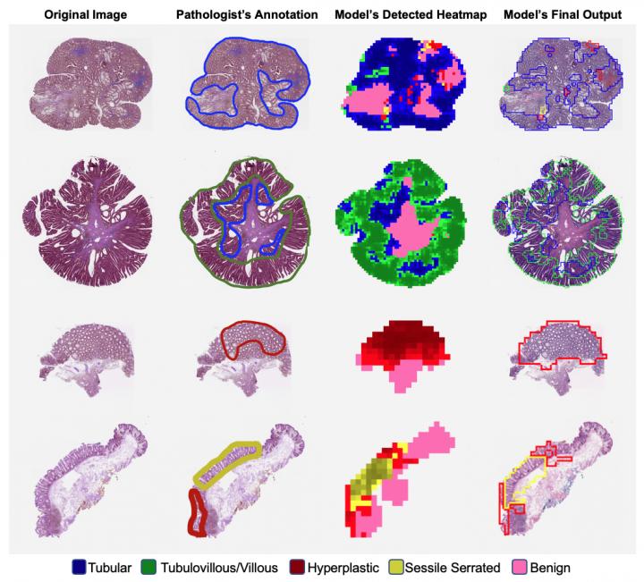 Artificial intelligence might help improve the classification of colorectal polyps