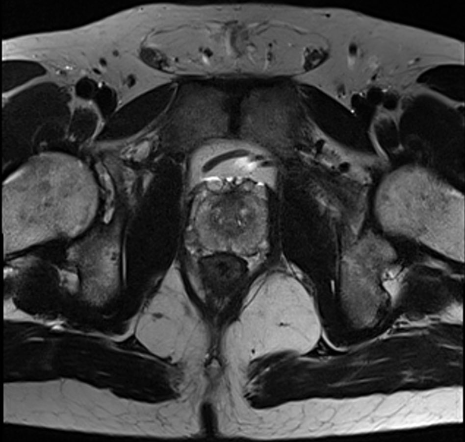 Study brings mass biparametric MRI screening for prostate cancer a step closer
