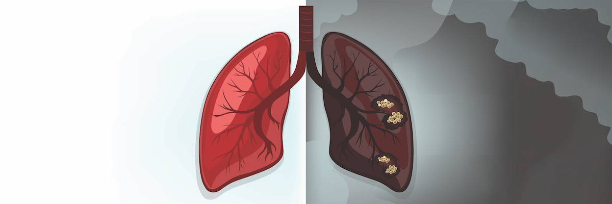 Immunotherapy plus chemo: benefits in lung cancer neoadjuvant treatment