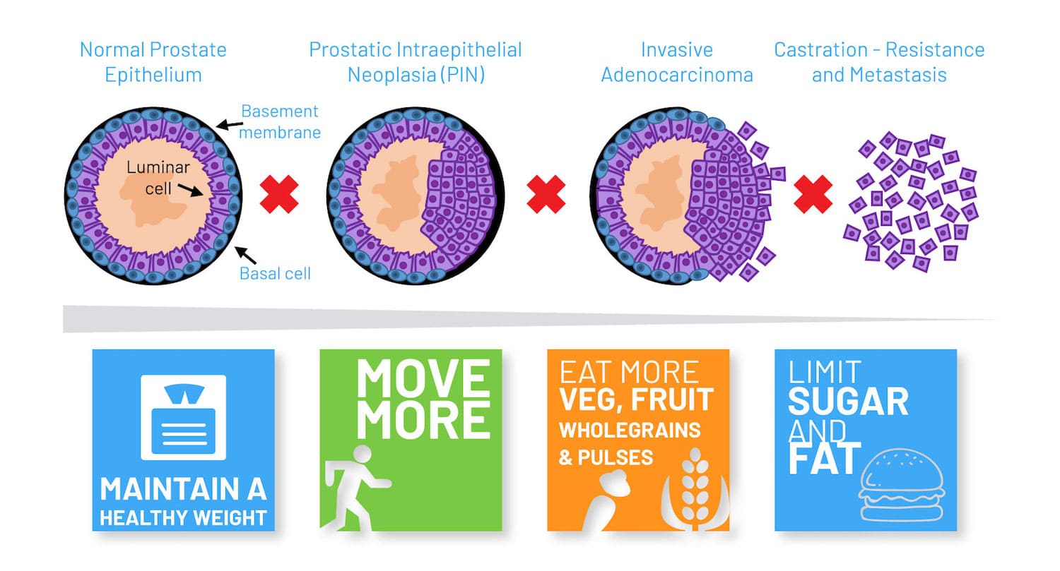 Prostate cancer: new leads for deterring progression
