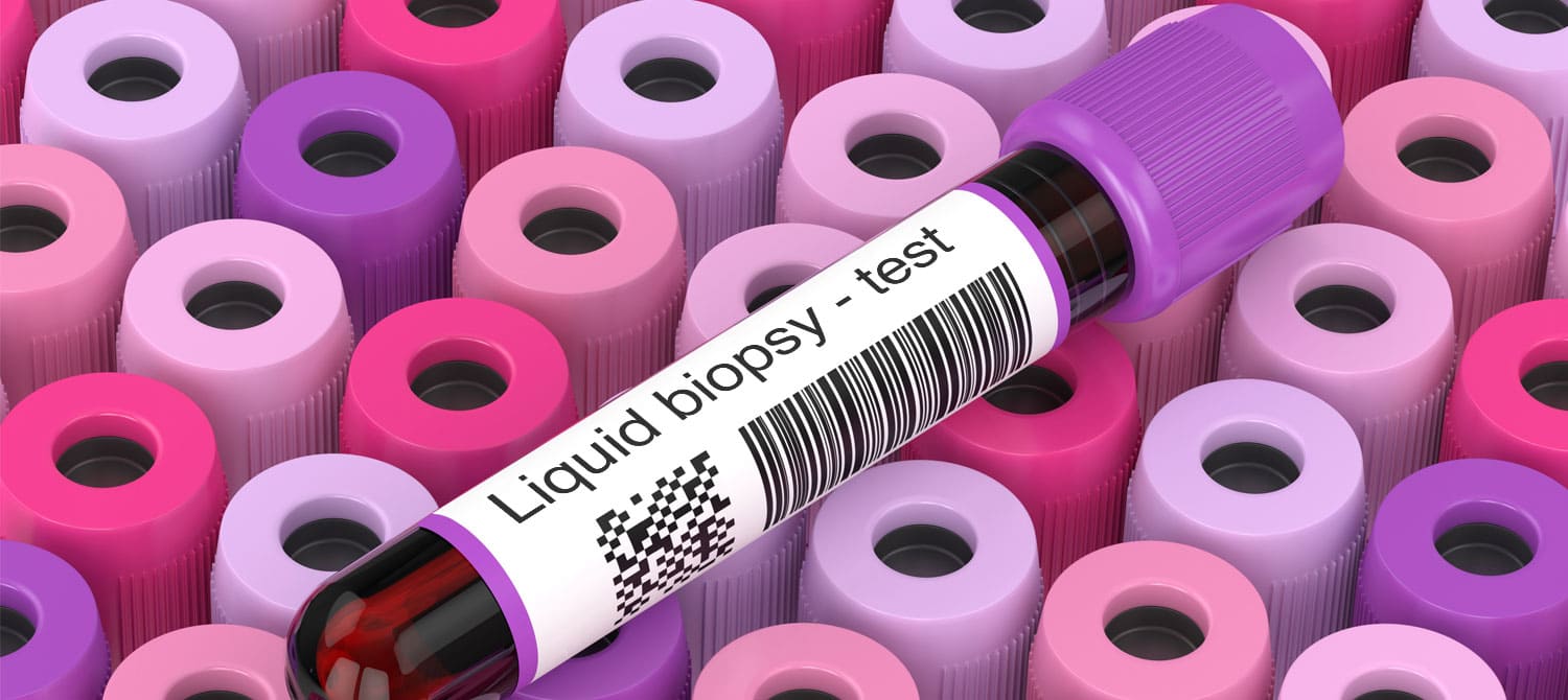 Circulating tumour DNA provides early warning of metastatic breast cancer 