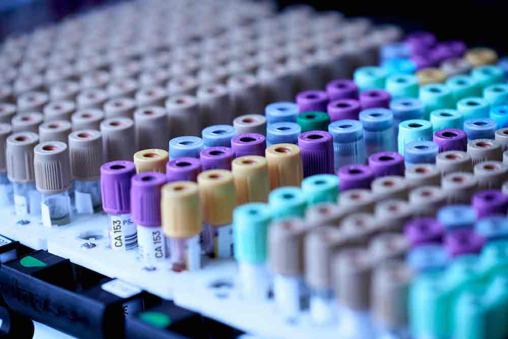 UK consensus group calls for biomarker testing at point of diagnosis