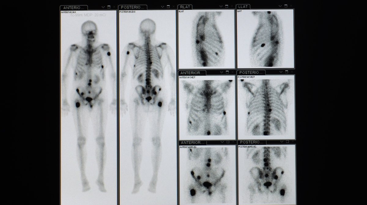 Radiotherapy benefits survival in patients with asymptomatic metastases