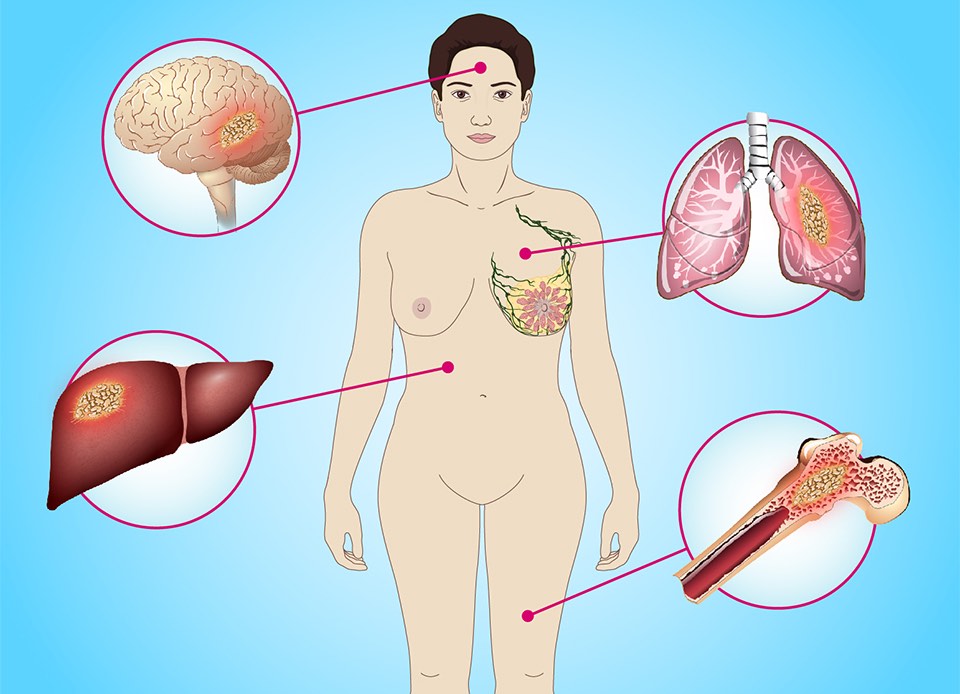 Study highlights need to reanalyse genomics and genetics of metastatic tumours
