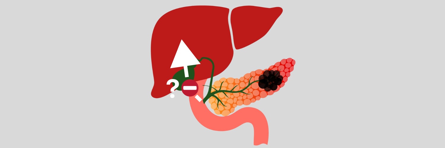 Potential new target to prevent pancreatic cancer from spreading to liver