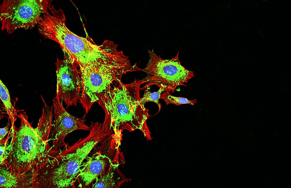 New drug combination offers potential to prevent bone metastasis