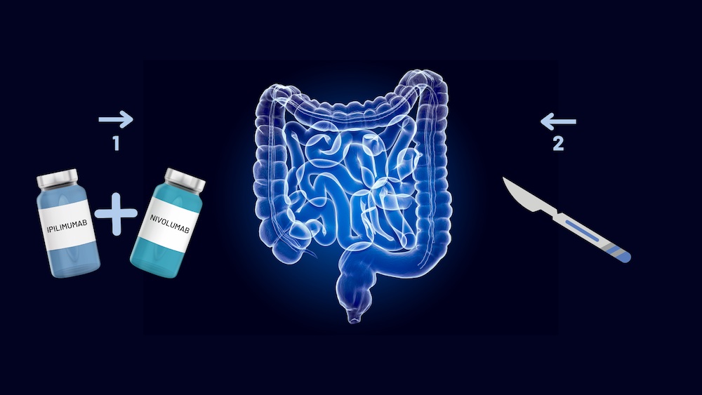 Neoadjuvant immunotherapy delivers unprecedented pathological response in mismatch repair deficient non-metastatic colon cancers