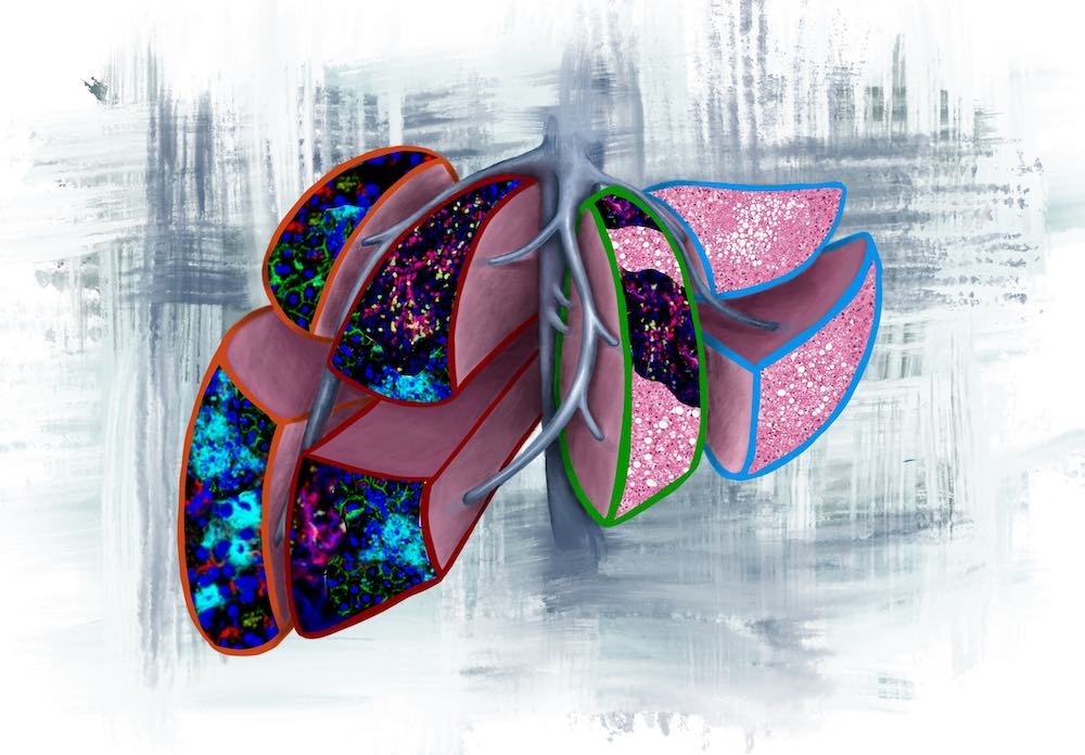 Liver biopsies can predict when and where pancreatic cancer will metastasise and may guide treatment of early-stage disease