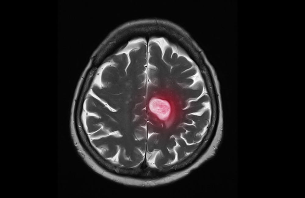 Antibody-drug conjugate proves effective against active brain metastases