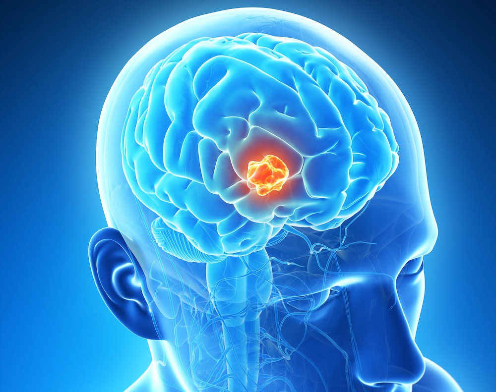 Radiotherapy prior to immunotherapy is the best treatment sequence for melanoma related brain metastases